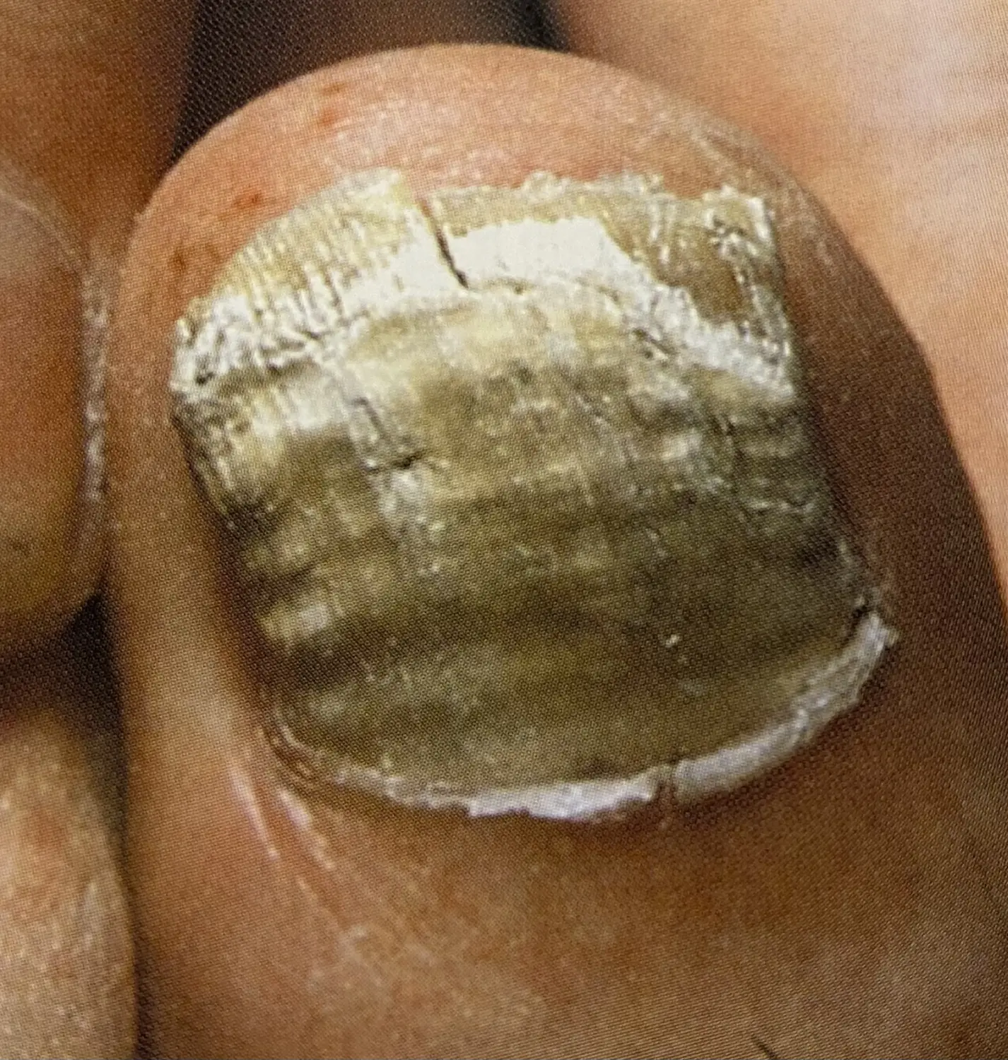 Nagelpilz von Podologische Praxis Ramelow