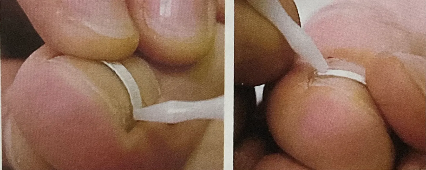 Spangentherapie von der Podologischen Praxis Ramelow