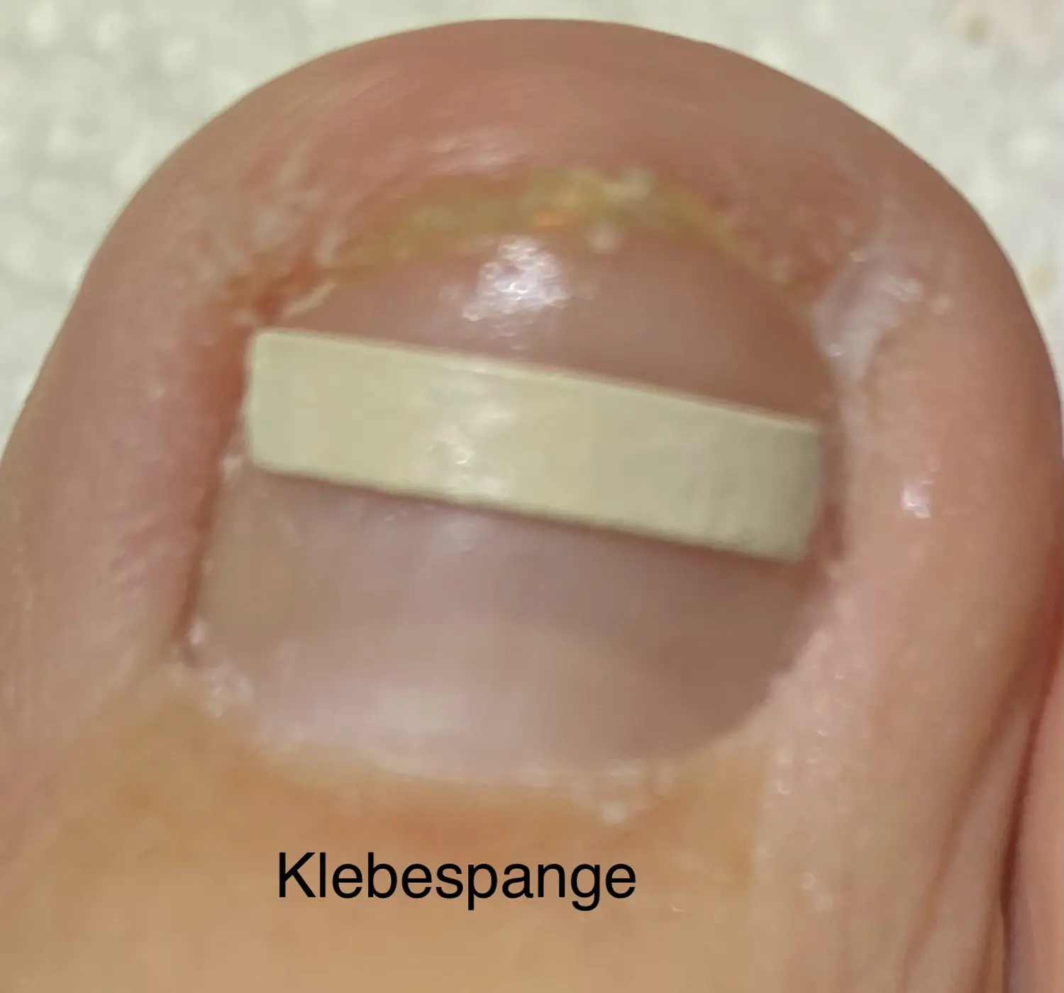 Nagelpilz von der Podologischen Praxis Ramelow