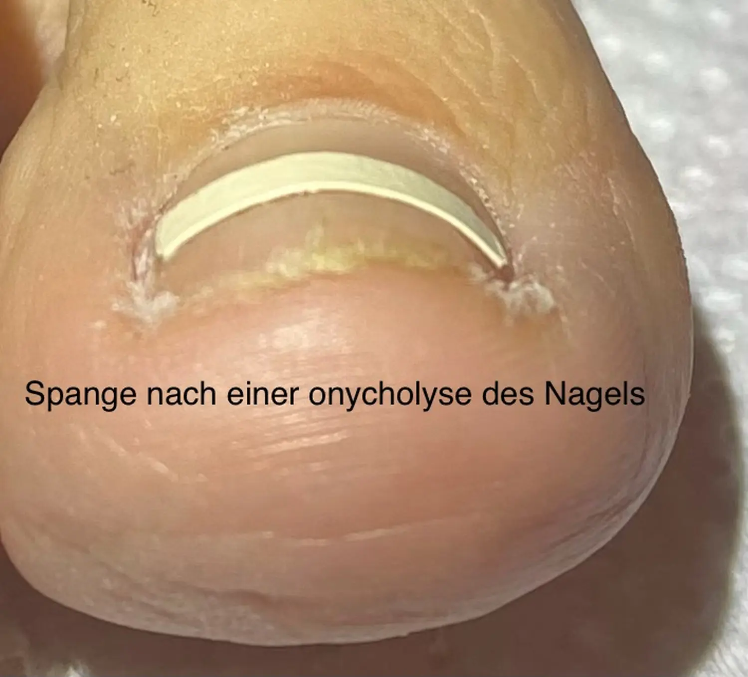 Nagelpilz von der Podologischen Praxis Ramelow