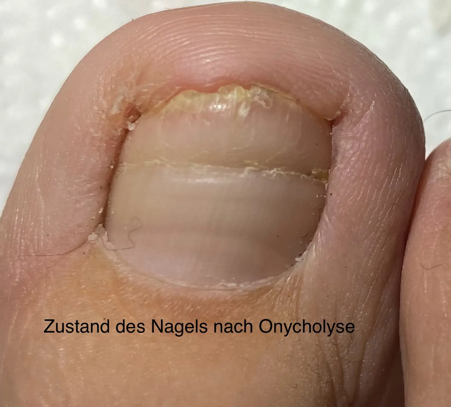 Nagelpilz von der Podologischen Praxis Ramelow