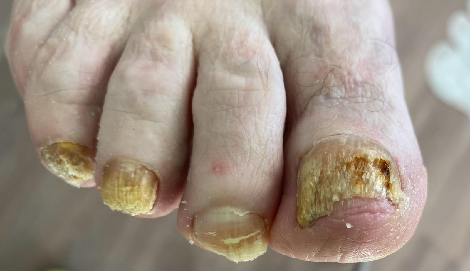 Nagelpilz von Podologische Praxis Ramelow