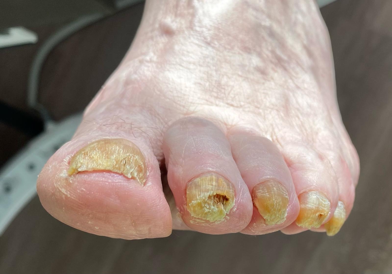 Nagelpilz von Podologische Praxis Ramelow